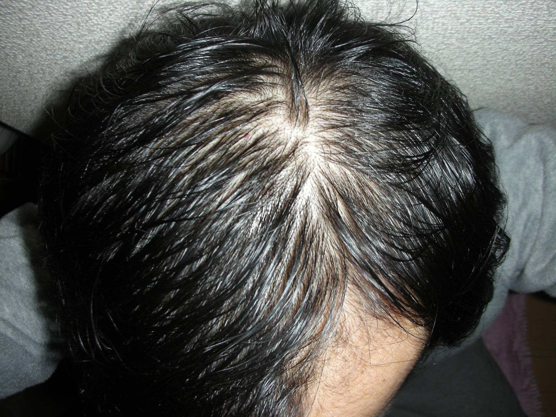 治療165日目 ポラリスnr 07で髪の毛がパリパリになる Aga治療日記